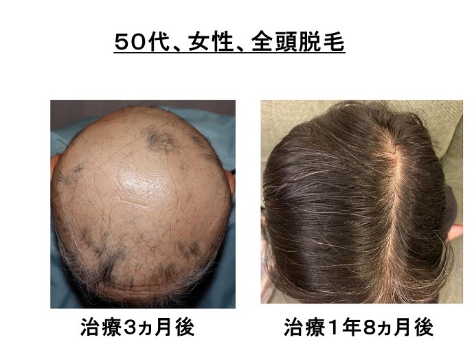 円形脱毛症　病院